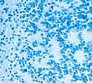 Ability Pharmaceuticals anuncia noves fites reguladores pel tractament ABTL0812 en el càncer pediàtric neuroblastoma