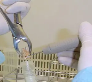Obtenen per primer cop material genètic antic del bacteri de la càries