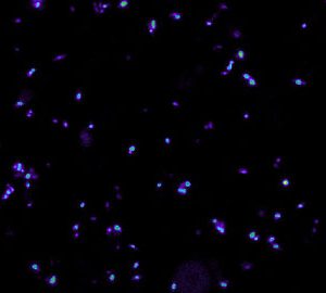 Una emulsió d’oli d’oliva i micobacteris millora el tractament de càncer de bufeta