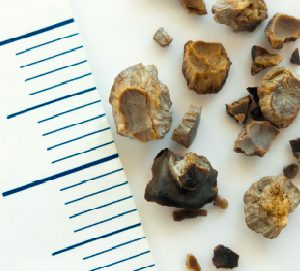 La UAB llicencia dues patents per millorar la diagnosi de la litiasi renal a l’empresa Devicare