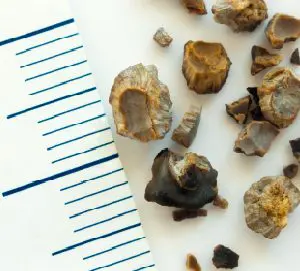 La UAB llicencia dues patents per millorar la diagnosi de la litiasi renal a l’empresa Devicare